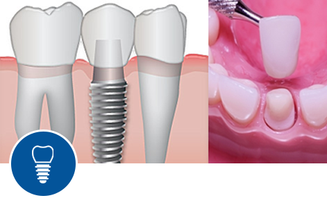 Prosthodontic Dentistry